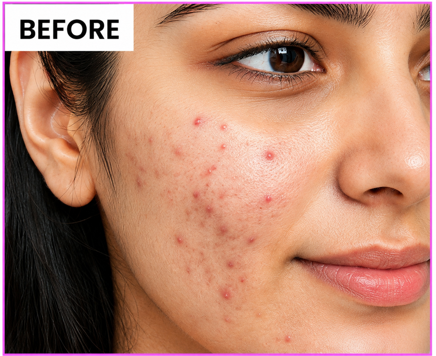 Before using Niacid Face Serum — acne, dark spots, uneven skin