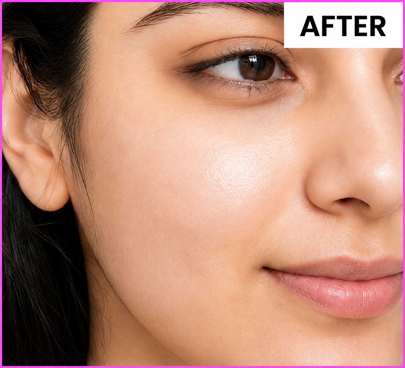 After using Niacid Face Serum — clear, glowing, even skin